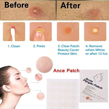 Face Acne Pimple Spot Scar Care Treatment Stickers